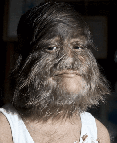 Meet the World’s Hairiest Girl