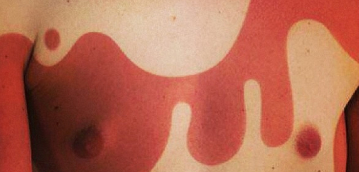 ‘Sunburn Art’: The Unhealthy, Summertime Fad That’s Sweeping The Web