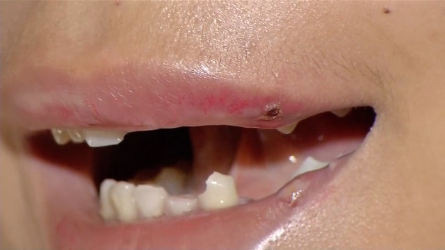 Travesti perde oito dentes